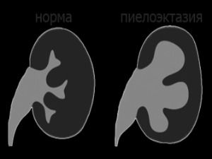 Увеличены и расширены лоханки почки у плода: причины и последствия