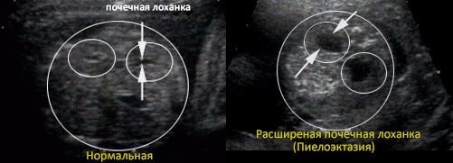 Увеличены и расширены лоханки почки у плода: причины и последствия
