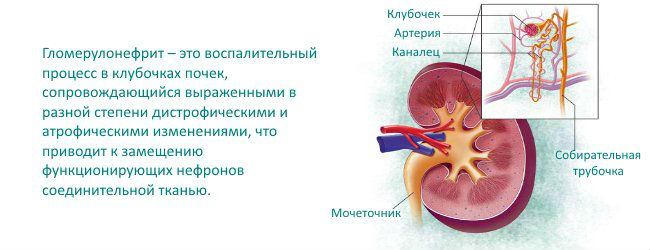 Гломерулонефрит: симптомы и лечение, что это такое, профилактика