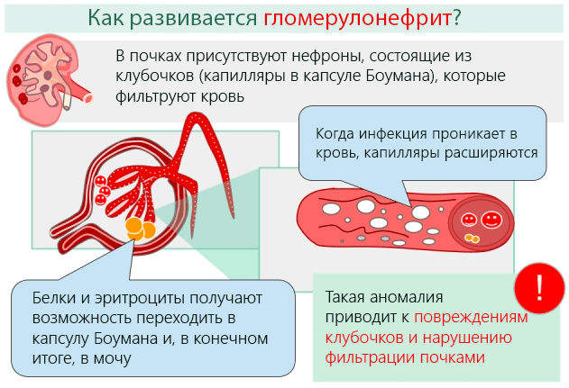 Гломерулонефрит: симптомы и лечение, что это такое, профилактика