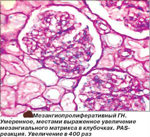 Гломерулонефрит: симптомы и лечение, что это такое, профилактика