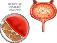 Цистит на нервной почве: может ли быть от нервов, лечение, симптомы