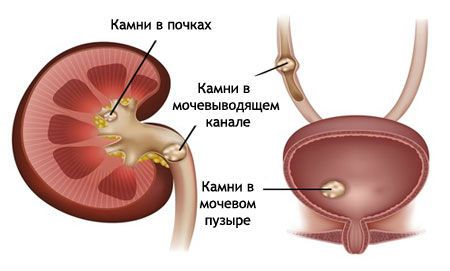 Почему болят почки и повышается температура, что с этим делать
