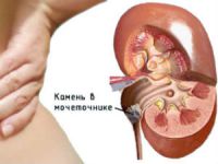 Камень в мочеточнике: как вывести и что делать, если застрял, симптомы