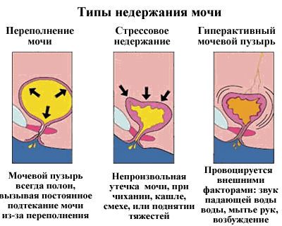 Недержание мочи у пожилых женщин и лечение (таблетки, лекарства, препараты)
