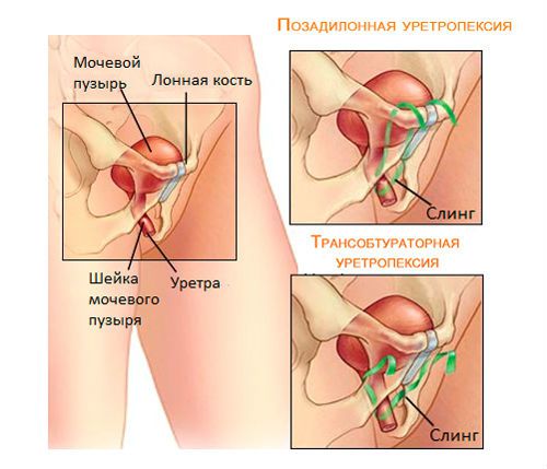 Недержание мочи у пожилых женщин и лечение (таблетки, лекарства, препараты)