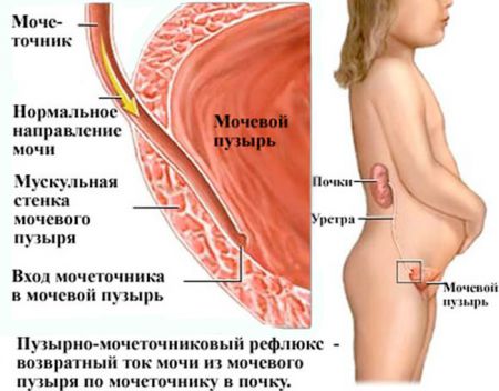 Рефлюкс почки и мочевого пузыря у детей: симптомы, лечение