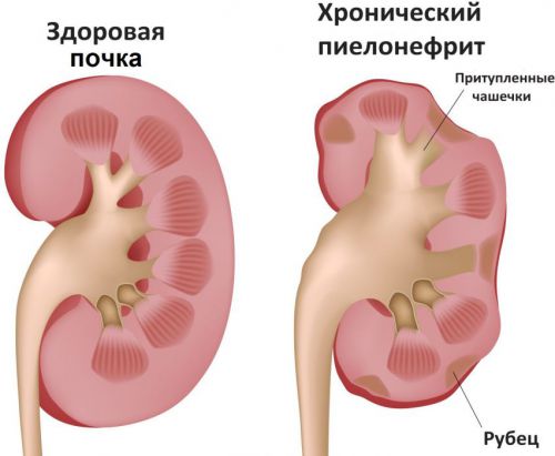 Почечная недостаточность: симптомы у женщин, признаки, лечение