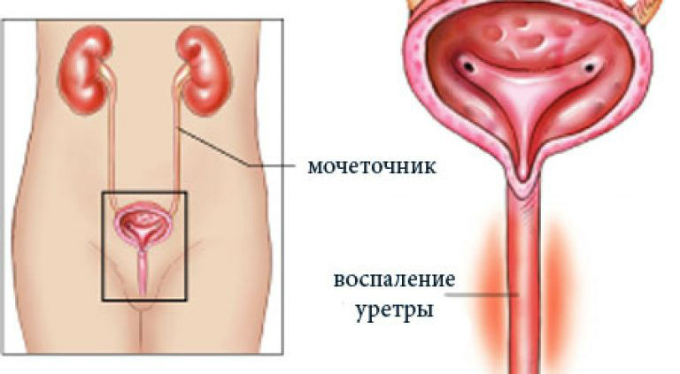 Неприятные ощущения в мочеиспускательном канале у женщин (дискомфорт)