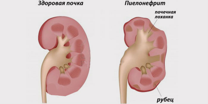 Острый пиелонефрит: симптомы, лечение, диета при заболевании у взрослых