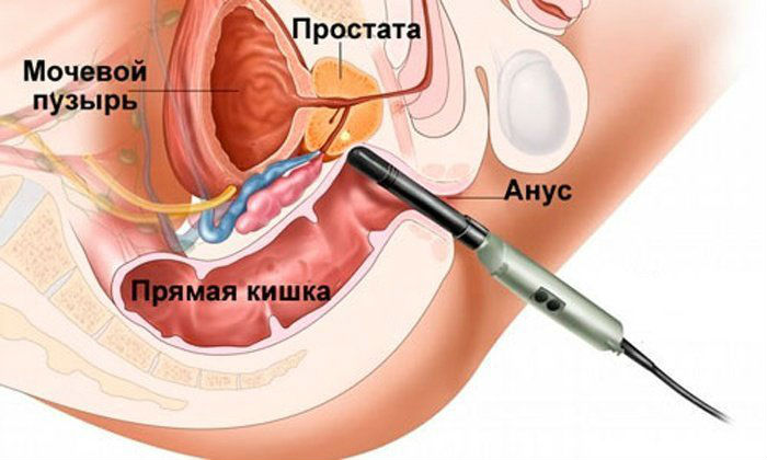 Опухоль мочевого пузыря у женщин и мужчин: симптомы, лечение, классификация