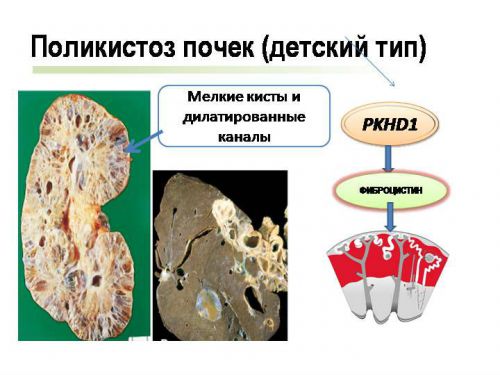 Поликистоз почек: что это такое, лечение и диета, симптомы
