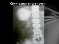 Аномалии развития почек: почечные пороки, их виды, симптомы