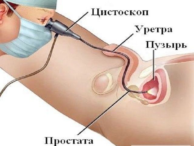 Полип уретры у женщин: операция, лечение, причины и симптомы