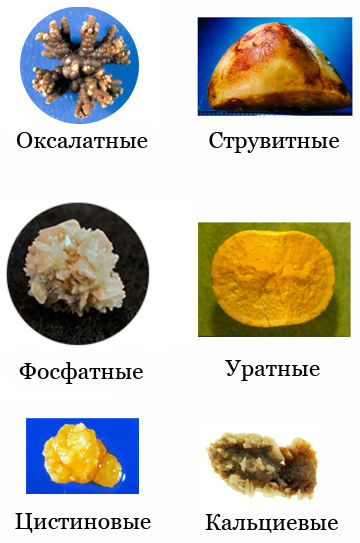 Нефролитиаз почек (правой, левой): что это такое, лечение и симптомы