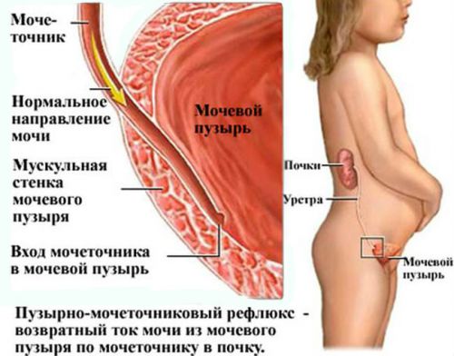 Острый пиелонефрит у детей: симптомы, лечение и причины