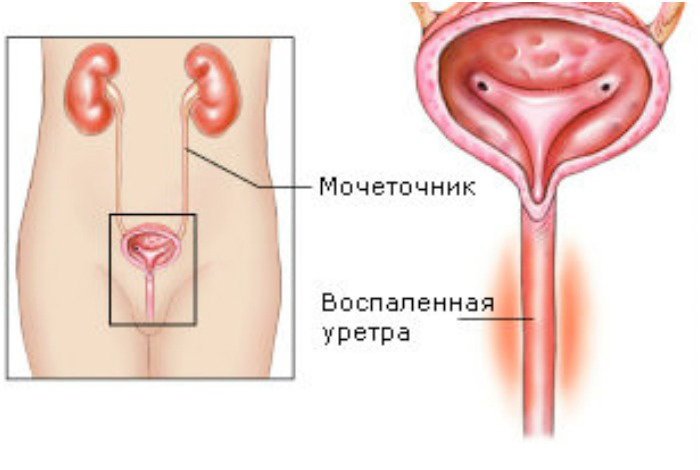 Острый уретрит у мужчин и женщин: симптомы, лечение