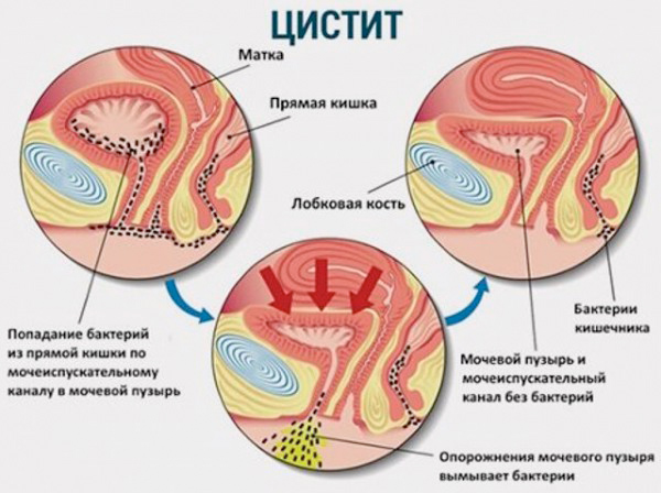 Уреаплазма и цистит: вызывает ли одно заболевание другое