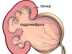 Гидронефроз почек у новорожденных детей: что это такое и методы лечения