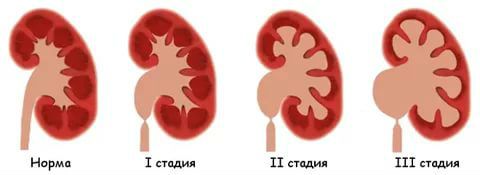 Гидронефроз почек у новорожденных детей: что это такое и методы лечения