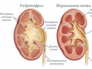 Гидронефроз почек: что это такое, исход заболевания, симптомы и лечение