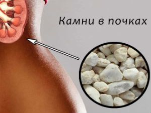 Конкременты в почках (левой, правой): что это такое и причины их образования