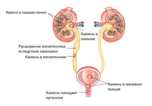 Конкременты в почках (левой, правой): что это такое и причины их образования