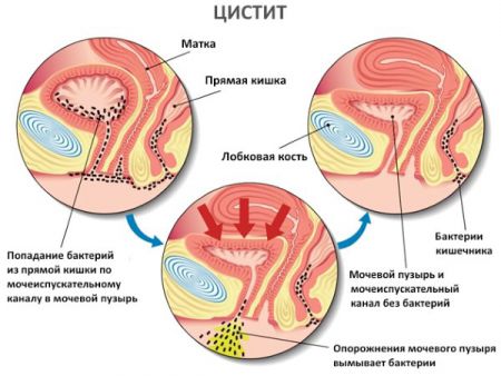 Рецидивирующий цистит у женщин: лечение и причины заболевания, профилактика