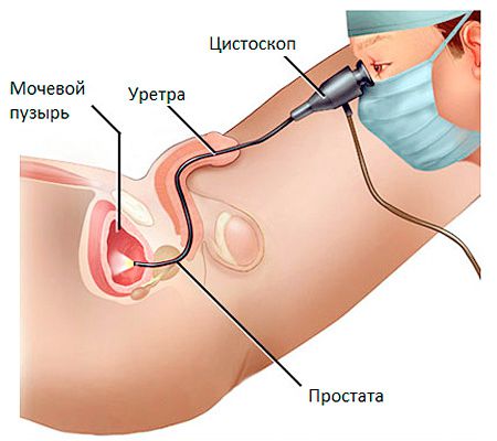 Рак уретры: симптомы у женщин и мужчин, лечение
