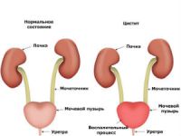 Острый цистит у женщин, мужчин, детей: симптомы, лечение (препараты)