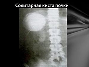 Солитарная киста левой и правой почки: причины и лечение