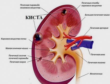 Солитарная киста левой и правой почки: причины и лечение