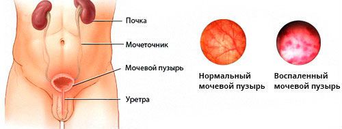 Бывает ли цистит у мужчин и что это такое: признаки и лечение мужского цистита