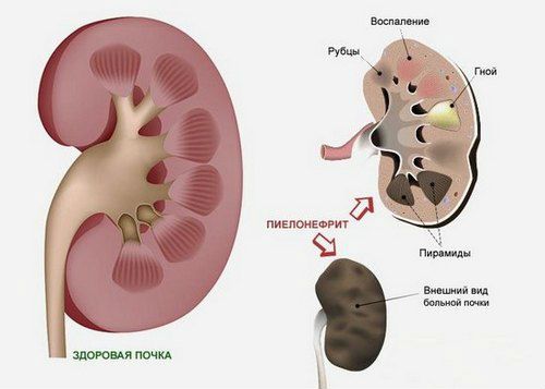 Хронический пиелонефрит почек: симптомы и лечение, что это такое