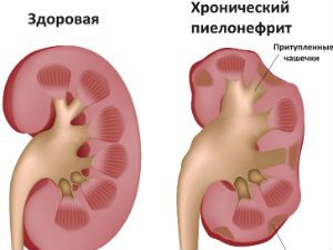 Пиелонефрит у мужчин: симптомы и лечение