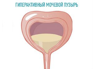Гиперактивный мочевой пузырь у женщин, мужчин и детей: лечение, симптомы