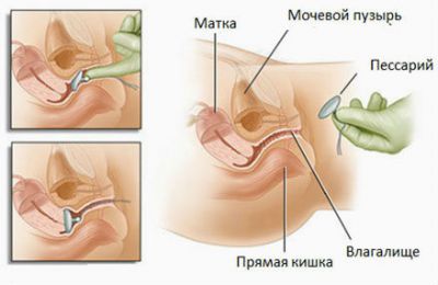 Опущение мочевого пузыря у женщин: симптомы и лечение