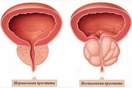 Курение и простатит, можно ли курить при хронической форме заболевания или нет