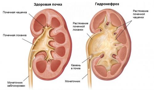 3 почки у человека: причины образования трех почек, может ли такое быть