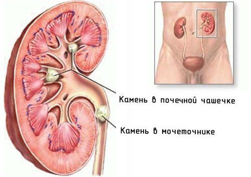 Мочевыводящие пути: их строение и заболевания, болезни у женщин
