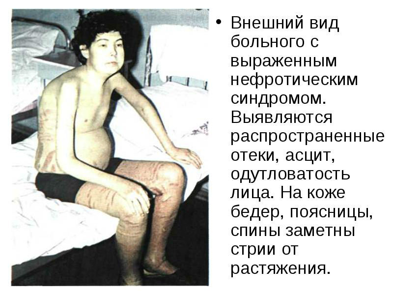 Диета для почек: меню почечной диеты «стол номер 7», правильное питание