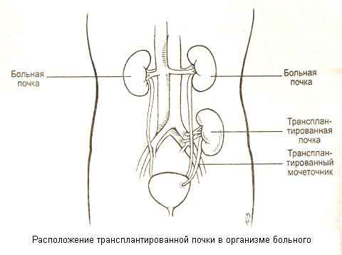 Пересадка почки: жизнь после трансплантации, диета, отзывы