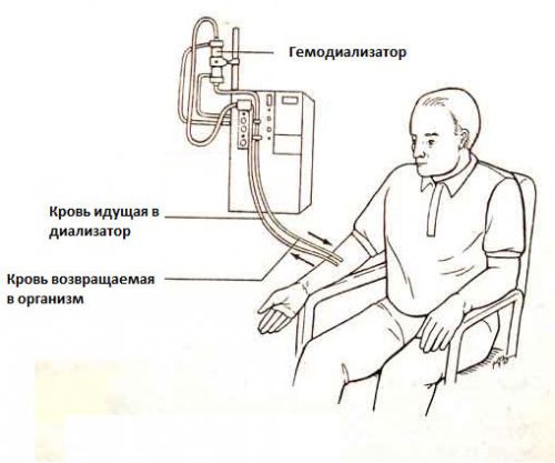 Кальцинаты в почках: что это такое, лечение микрокальцинатов