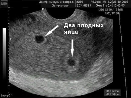 ХГЧ в моче по дням от зачатия: уровень содержания, когда появляется гормон