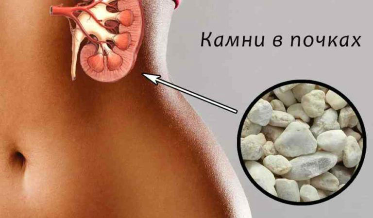 Болят почки после алкоголя: что делать, как лечить боли от пива