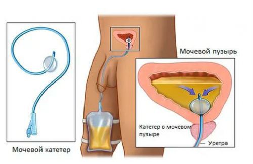 Удаление мочевого пузыря: радикальная цистэктомия, последствия, отзывы