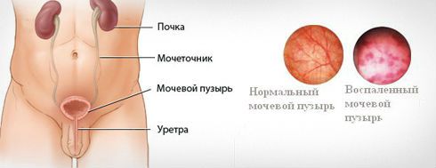 Причины возникновения цистита: отчего он бывает, появляется у девушек