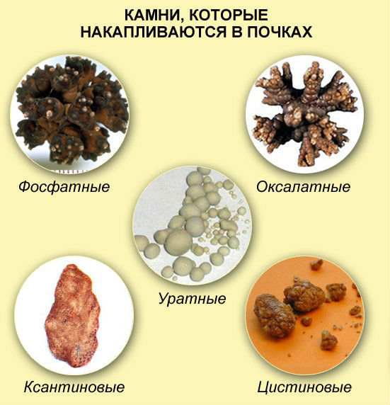 Что можно есть при камнях в почках и чего употреблять нельзя