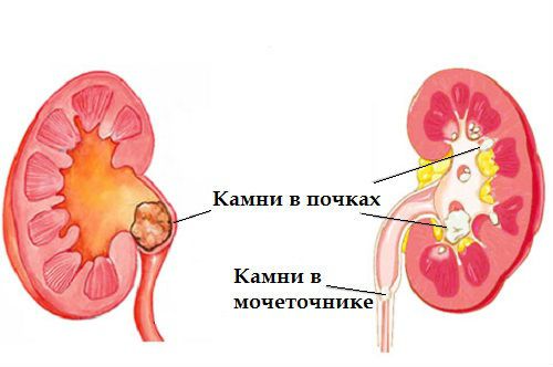Соли и фосфаты в моче у ребенка: причины появления аморфных кристаллов