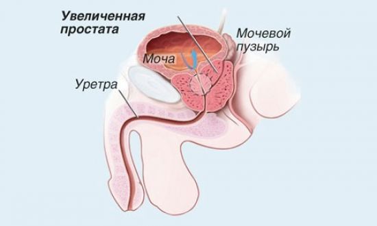 Лечение простатита в Израиле: как лечат, программа обследования пациента, известные клиники